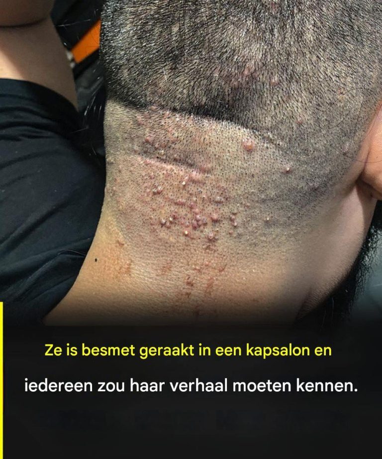 Waarschuwing voor kappers: een veelvoorkomende infectie na een knipbeurt en hoe u deze kunt voorkomen.