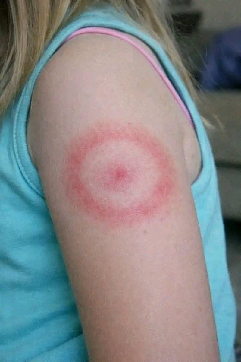 Mijn dochter werd wakker met een vreemde rode ring op haar arm: een gids voor ouders over ringvormige huiduitslag (en…