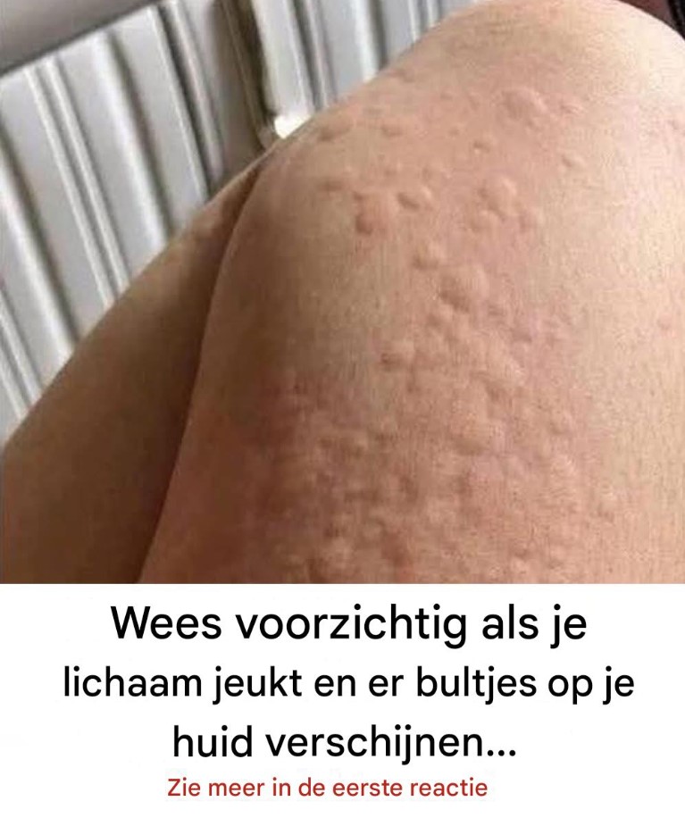 Waarom ontstaan ​​netelroosplekken op de huid? Verrassende oorzaken die je misschien niet kent.