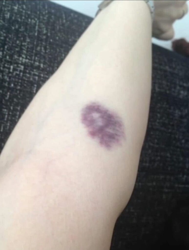 Wees voorzichtig als je deze blauwe plekken op je lichaam krijgt: wat betekenen ze eigenlijk?