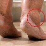 Zeg vaarwel tegen gezwollen voeten met deze natuurlijke en effectieve tips voor snelle verlichting.