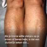 Waarom krijg ik in de zomer witte vlekjes op mijn huid en hoe kan ik die behandelen? Een dermatoloog geeft…