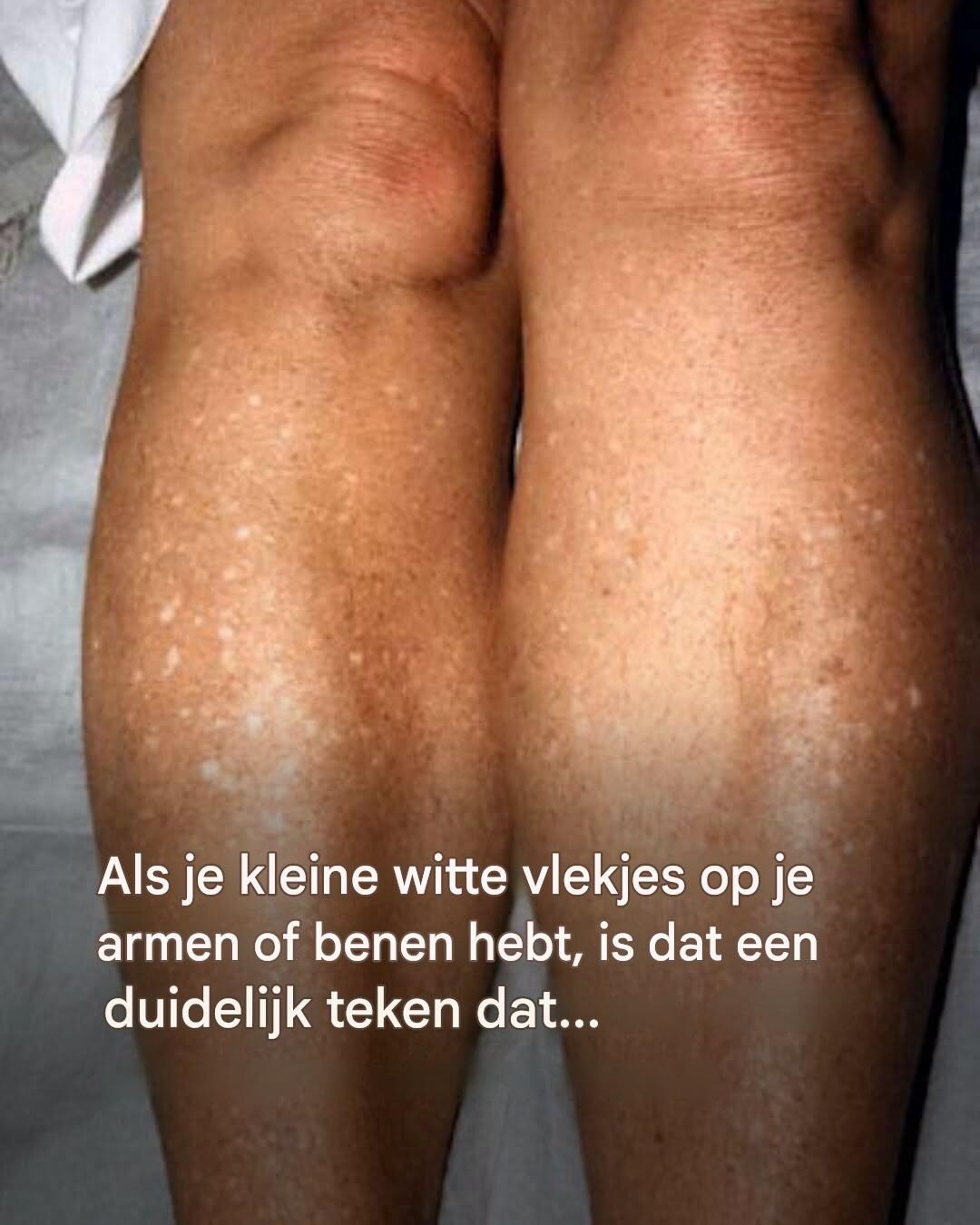 Waarom krijg ik in de zomer witte vlekjes op mijn huid en hoe kan ik die behandelen? Een dermatoloog geeft…