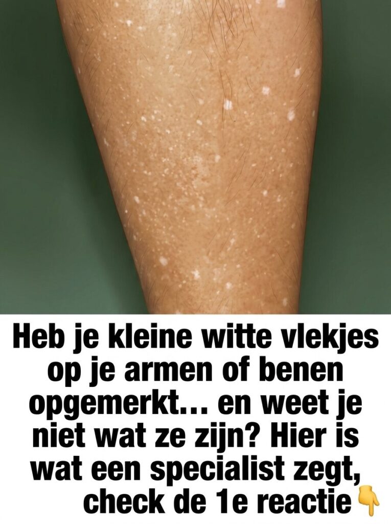 Deze Ontbrekende Vitamines Veroorzaken Witte Vlekken Op Je Huid (En Zo Kom Je Ervan Af!)
